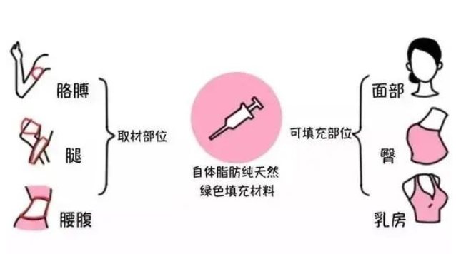 自體脂肪填充後(hòu)效果