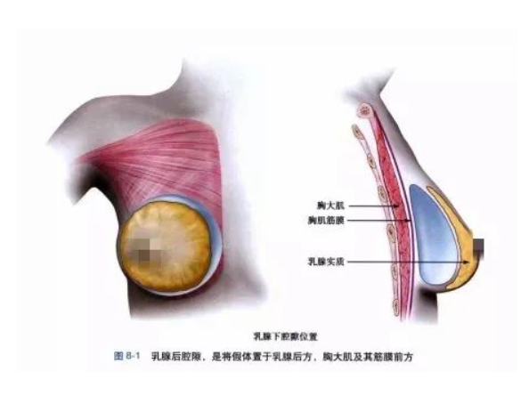 自體脂肪豐胸多少錢 