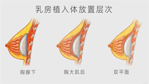 假體隆胸手感好(hǎo)嗎